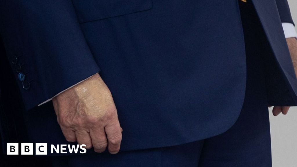 Trump diagnosed with vein condition, White House says