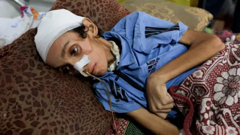 One in five children in Gaza is malnourished, UN aid agency says